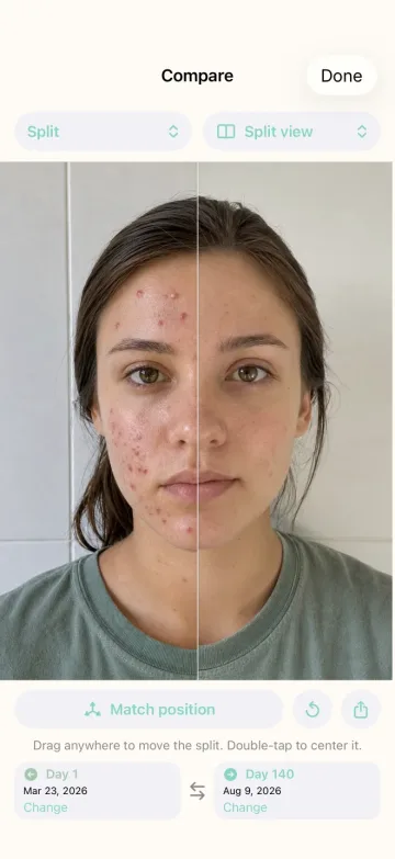 IsoPal split-view comparison between treatment day 1 and day 140
